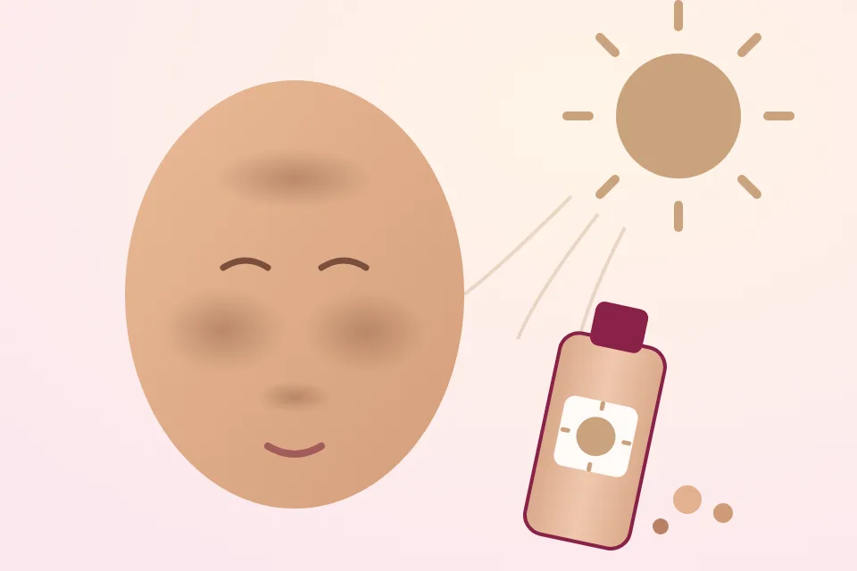 What works for melasma and hyperpigmentation: sunscreen, skincare actives and prescription options